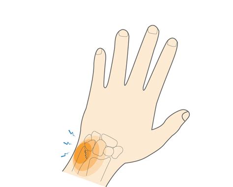 What Is Ulnar Styloid Fracture