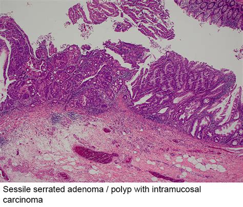 Pathology Outlines - Sessile serrated adenoma