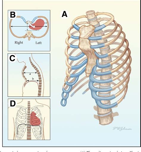 Chest Wall Abnormalities