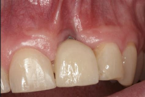 Dental Tissue Grafting for Receding Gums in Oakville & Mississauga