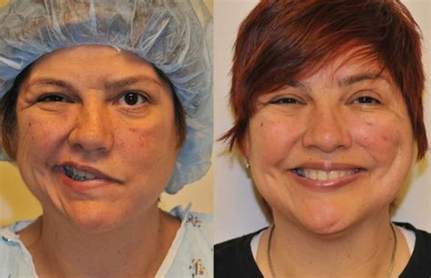 Reconstructive Surgery: Facial Paralysis, NF, Rhinoplasty - LA, Pasadena