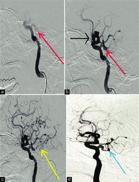 (a) Early filling of PTA (red arrow) from ICA injection (b) filling of... | Download Scientific ...