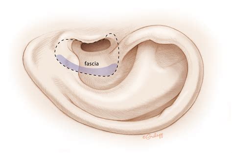 Mastoid Surgery