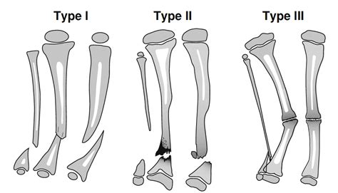 Congenital Pseudarthrosis of the Tibia - Paley Orthopedic & Spine Institute