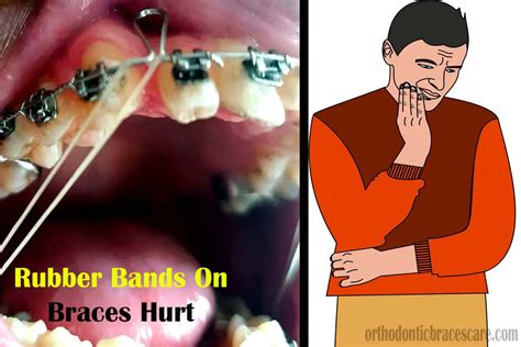 Why Do Rubber Bands On Braces Hurt? [9 Pain Relieving Tips] - Orthodontic Braces Care