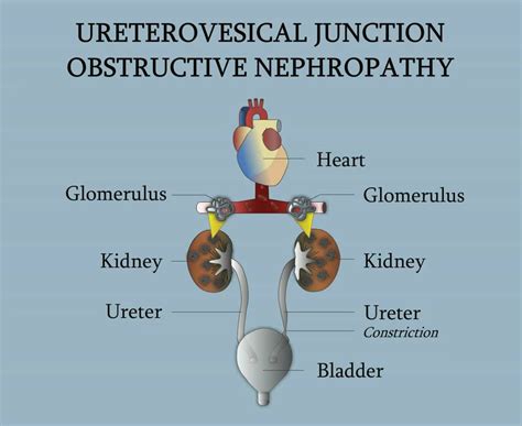 Ureterovesical Junction - Obstructive Nephropathy - YouTube