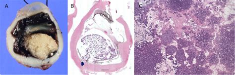 Pathology of the enucleated eye. A, Gross photograph of the enucleated ...