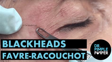 Blackheads - Favre Racouchot - Blackheads & Whiteheads Galore - Dr ...