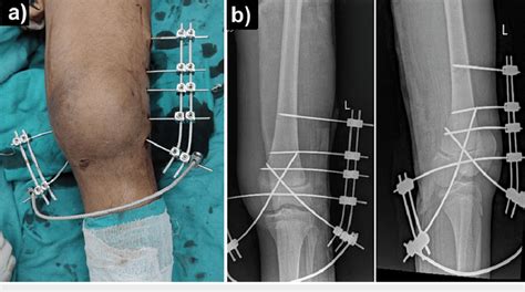 Closed reduction internal fixation of the distal femoral physeal slip... | Download Scientific ...