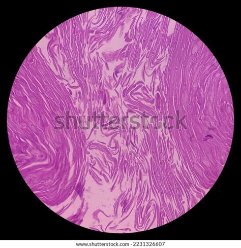 Finger Biopsy Finger Cancer Invasive Squamous Stock Photo 2231326607 ...