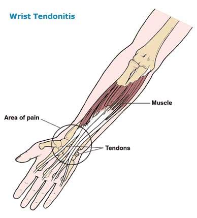 Picture Of Forearm Tendons : How To Get Rid Of Forearm Tendonitis With ...