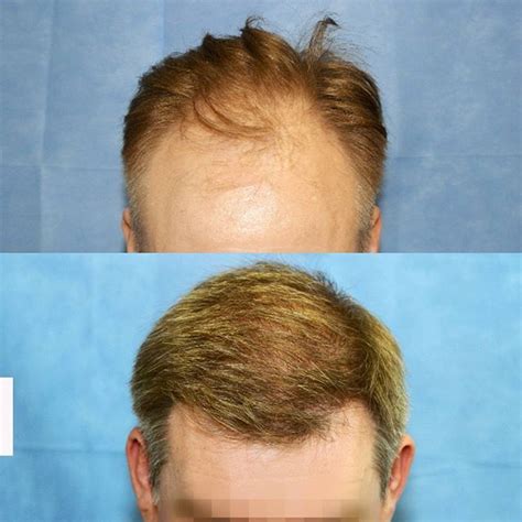 Receding hair line fixed •Before and After• 2811 grafts were ...