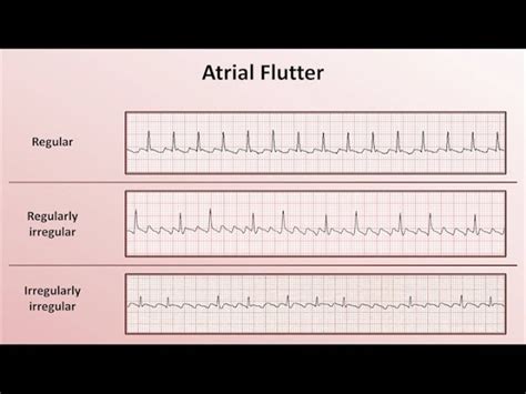 svt ecg