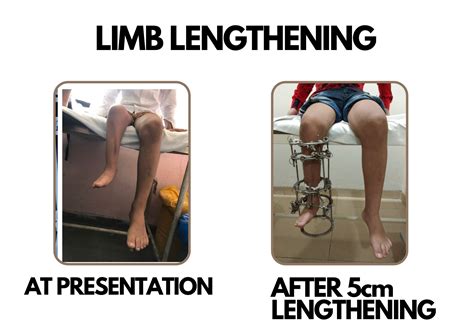 Limb lengthening :: Dr Deepak khurana- Paediatric Orthopaedic Surgeon