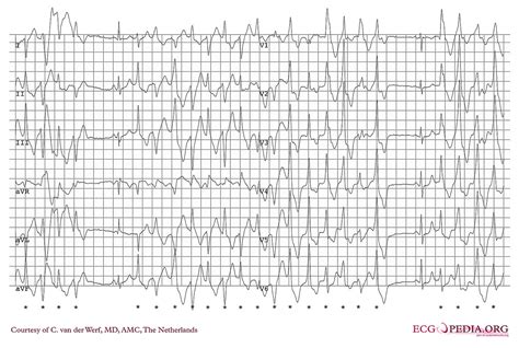 Ventricular tachycardia classification - wikidoc