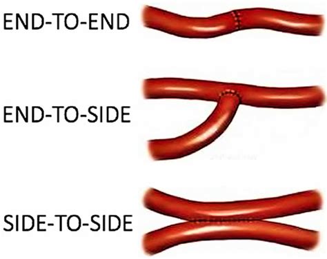 Anastomosis surgery, vascular anastomosis and bowel anastomosis