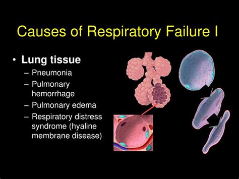 PPT - Causes of Respiratory Failure I PowerPoint Presentation, free ...