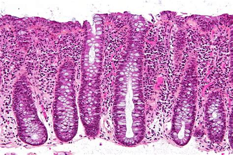 Lymphocytic colitis - Libre Pathology