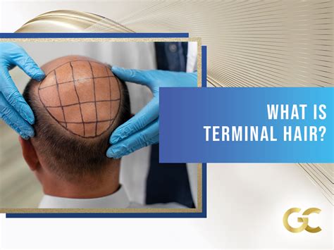 What is Terminal Hair? - Gold City Best Hair Transplant Turkey