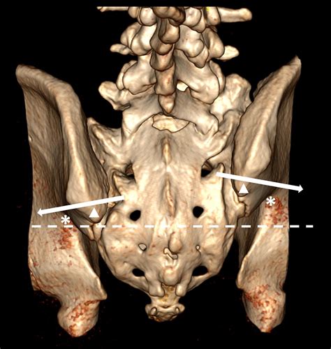 The posterior superior iliac spine and sacral laminar slope: key anatomical landmarks for ...