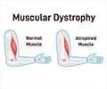 Muscle Atrophy in Legs: A Closer Look at Calf Muscle Atrophy