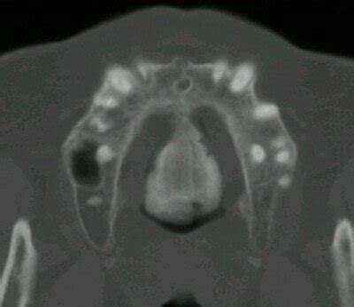 Torus Palatinus - Causes, Treatment and Surgery (Removal) - (updated in 2022)