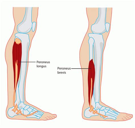 Peroneus tendinopathie: Wat is het precies? | Shockwave.nl