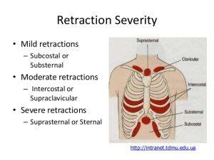 Image result for suprasternal retraction (With images) | Poverty children, Children, Severe