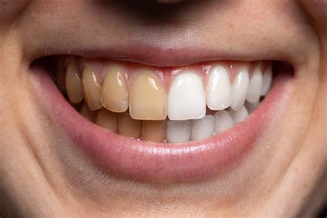 Are At-Home Teeth Whitening Kits Safe/Good? | Mona Vale Dental