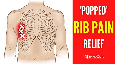 How to Fix a Rib Out of Place | SpineCare