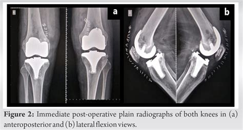 Delayed Recovery of Idiopathic Common Peroneal Nerve Palsy After Total ...