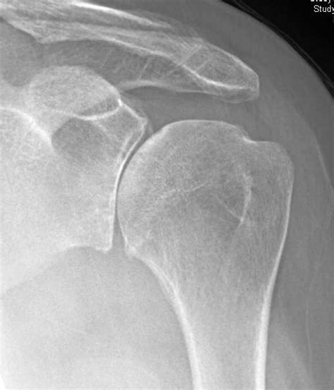 Shoulder Arthritis / Rotator Cuff Tears / Shoulder Pain : Posterior glenoid bone loss and total ...