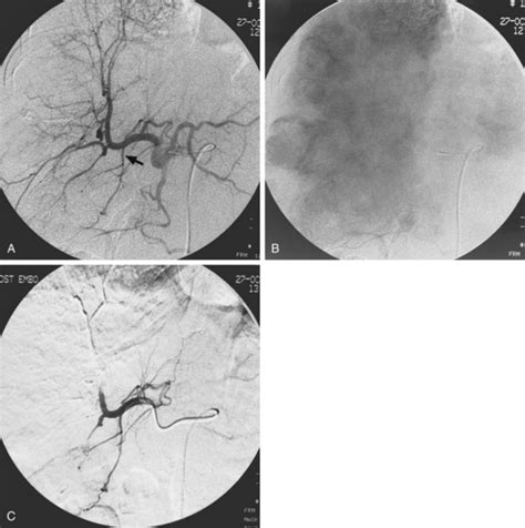 Interventional oncology | Radiology Key