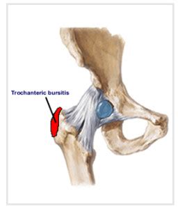 Trochanteric Bursitis Natural Treatment | OSMO Patch US