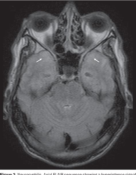 Figure 2 from Differential diagnosis of temporal lobe lesions with hyperintense signal on T2 ...