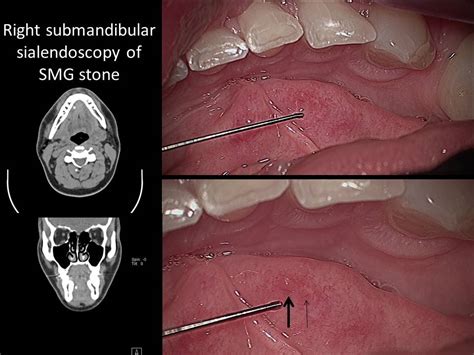 Bartholin's Duct anatomy | Iowa Head and Neck Protocols