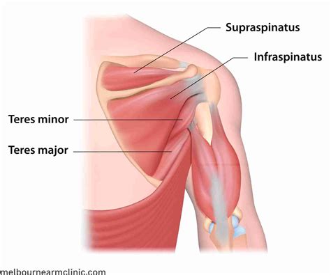 Supraspinatus Tear Causes & Treatment - Melbourne Arm Clinic