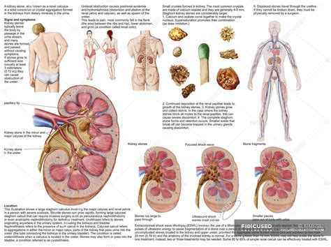 Medical chart with the signs and symptoms of kidney stones — renal pelvis, anatomy - Stock Photo ...