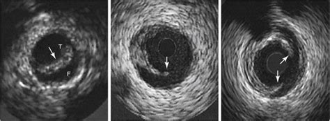 Intravascular Ultrasound | Radiology Key