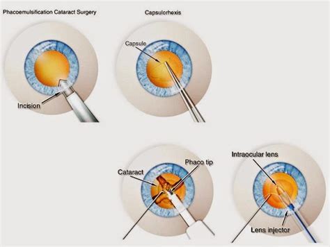 Eyedolatry: Laser Assisted Cataract Surgery: Is it Worth the Cost?