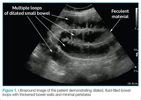 Case Report: Diagnosis of Small Bowel Obstruction With Bedside Ultrasound | MDedge Emergency ...