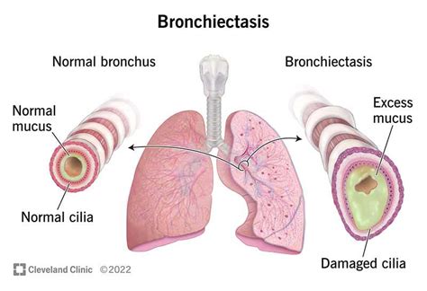 Bronchiectasis: Causes, Symptoms, Treatment & Prevention