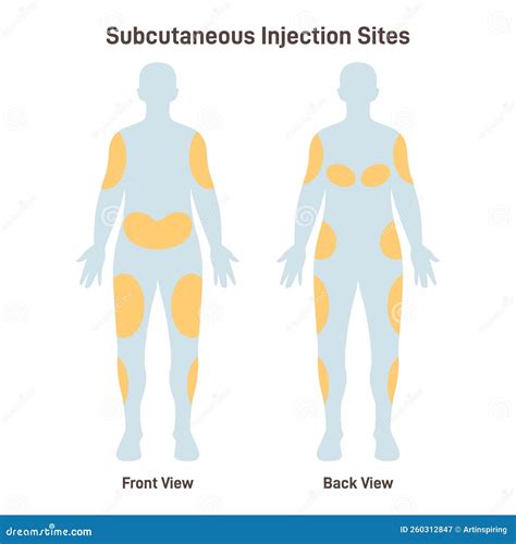 Subcutaneous Injection Sites. Medicine Injection Sites On The Human ...