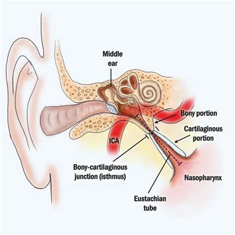 Eustachian Tube Balloon Dilation in Farmington Hills, MI