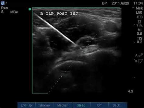 Iliopsoas Bursitis Injection