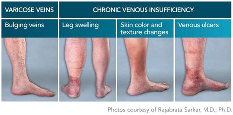 Chronic Venous Insufficiency (CVI) - Center for Advanced Cardiac and Vascular Interventions