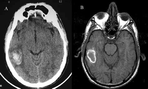 Brain Jack Image: Brain Ct Scan