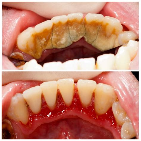 Dental teeth cleaning & Debridement Before & After photos