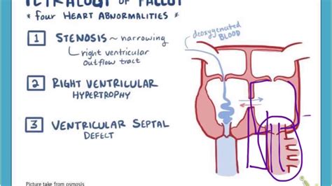 Right To Left Shunt - Respiratory failure - Shunting traffic around an ...