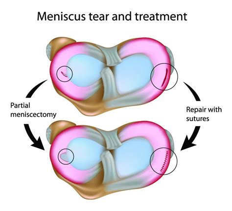 Answers to your questions about surgery to trim out a meniscus tear | Dr Geier